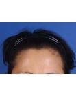 After Hair Transplant &nbsp;Hair Thinning